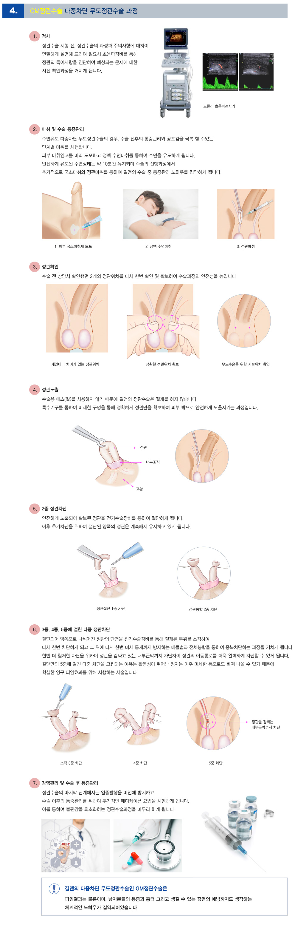 GM정관수술